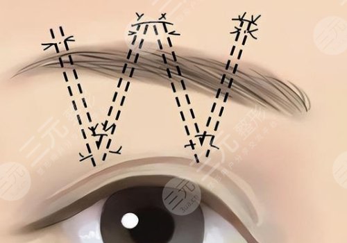 提眉術多久可以恢復自然？