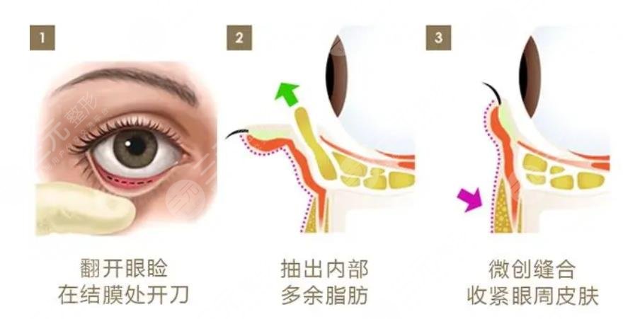 外切眼袋增生鼓包多久消退