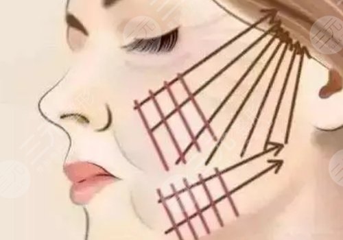 做完線雕多久可以恢復(fù)？