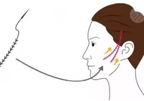 做完線雕多久可以恢復(fù)？