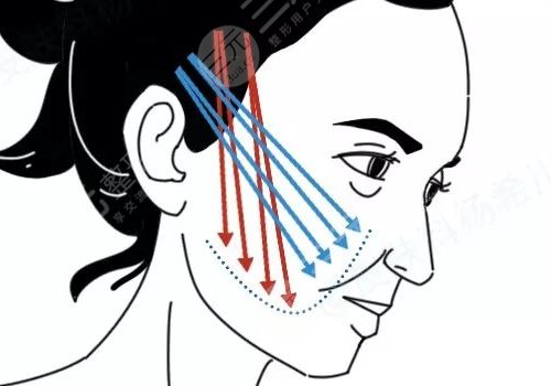 做完線雕多久可以恢復(fù)？