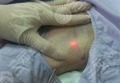 醫(yī)療方法去掉狐臭|醫(yī)美項(xiàng)目