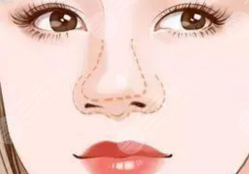 顧新安做鼻子怎樣？