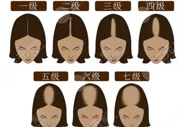 脫發(fā)1-7級(jí)程度