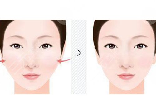 輪廓手術(shù)危險(xiǎn)嗎？