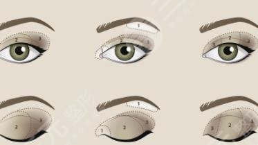 雙眼皮修復(fù)