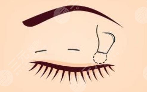 雙眼皮修復(fù)