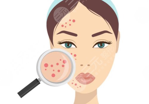 痘印怎么消除？