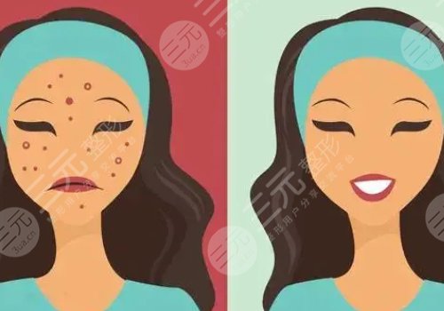 痘印怎么消除？