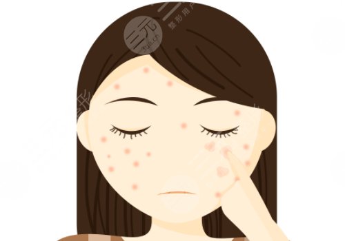 痘印怎么消除？