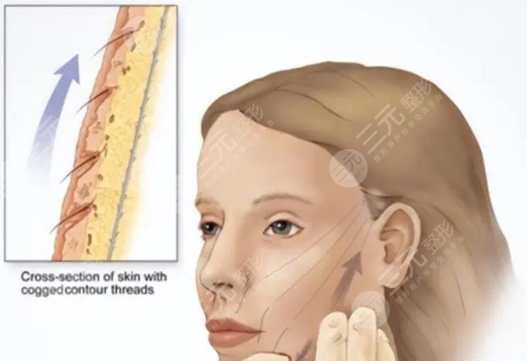 柳民熙醫(yī)生擅長項目科普