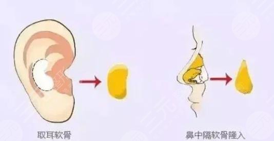 耳軟骨復(fù)合隆鼻