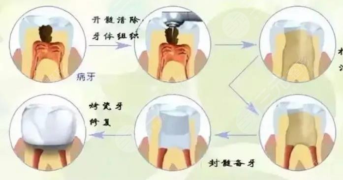 補(bǔ)牙封藥后疼正?常嗎?