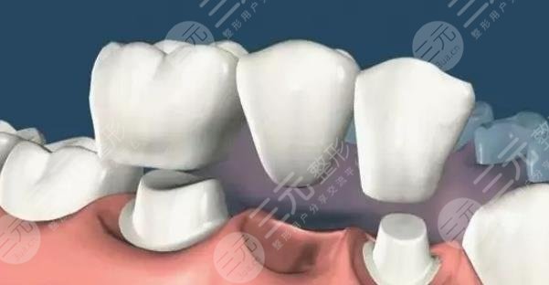 補(bǔ)牙封藥后疼正?常嗎?