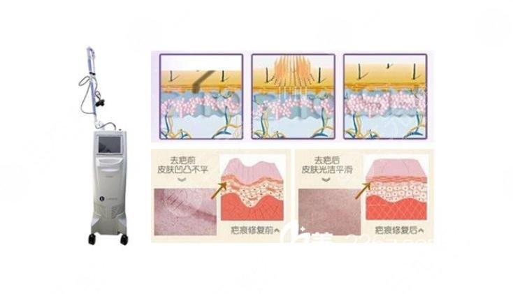 如何祛除臉上的疤痕?