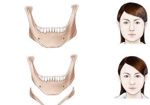 做輪廓手術(shù)多少錢費用是多少？