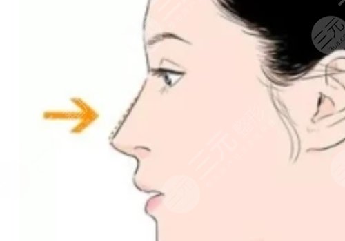 葉麗萍做鼻子怎么樣？