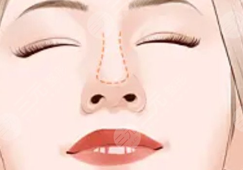 葉麗萍做鼻子怎么樣？