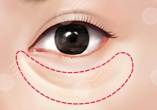 淚溝是怎么形成的？