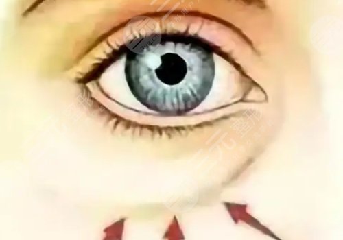 淚溝是怎么形成的？