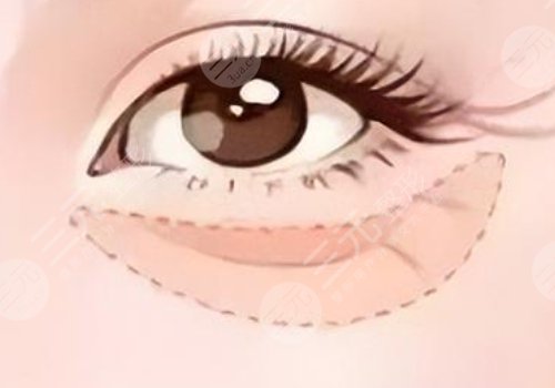 淚溝是怎么形成的？