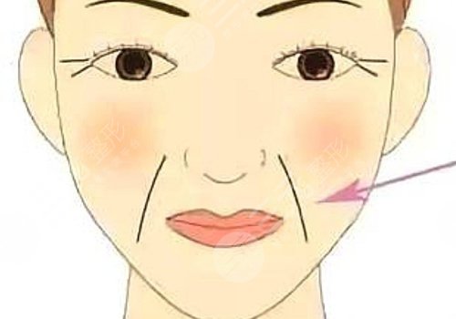 法令紋太深了有什么解決辦法？