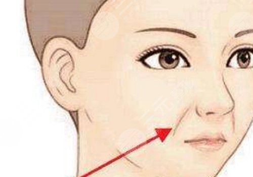 法令紋太深了有什么解決辦法？