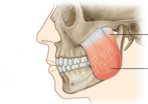 咬肌太大怎么辦如何讓咬肌變小？