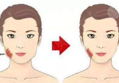 咬肌大怎么瘦下來