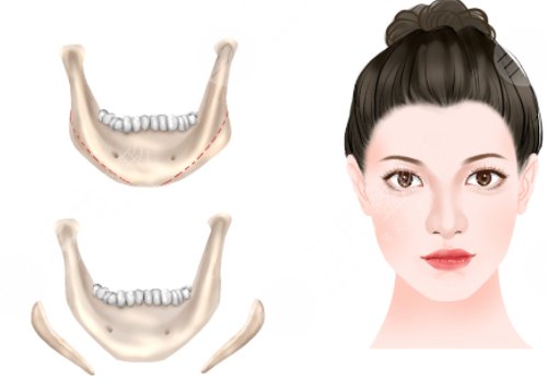 下頜角手術(shù)后頭套要戴多久？3-4周的時間？