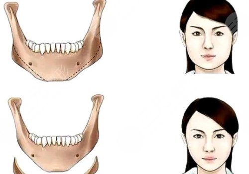 下頜角手術(shù)后頭套要戴多久？