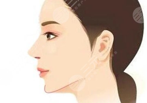 下頜角手術(shù)后頭套要戴多久？