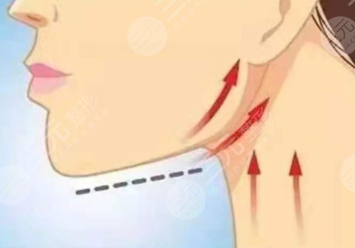 下頜緣提升怎么打？