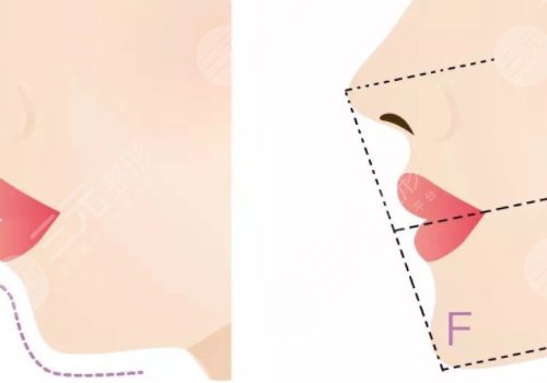 下頜緣提升怎么打？