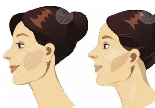 下頜緣提升怎么打？