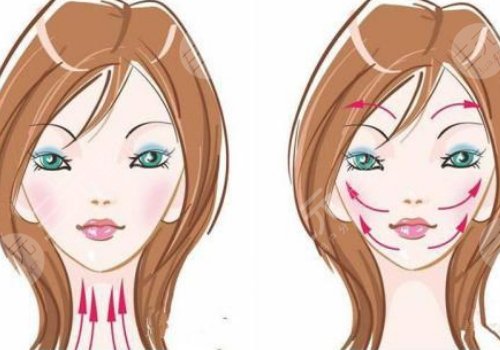 小v臉提升怎么做多少錢？