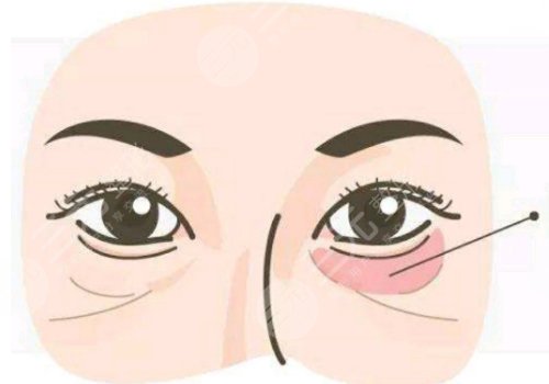 去黑眼圈和眼袋有效的方法是什么？眼周抗衰指南！