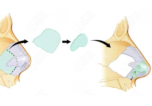 俞積貴做鼻子怎么樣？