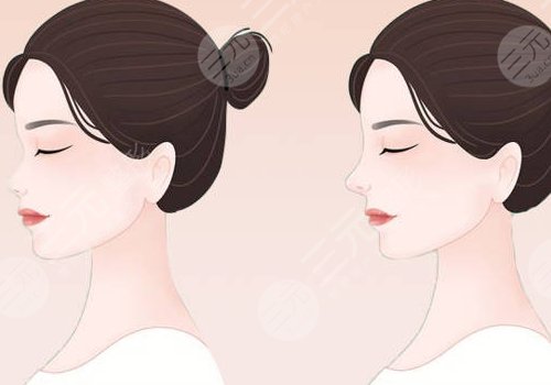 俞積貴做鼻子怎么樣？