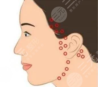 內(nèi)外輪廓固定