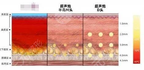 外輪廓固定提升打什么針？
