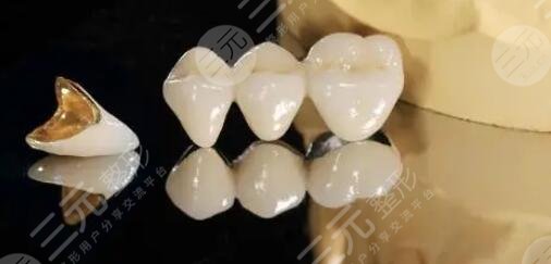 金鈀烤瓷牙價格一般是多少?