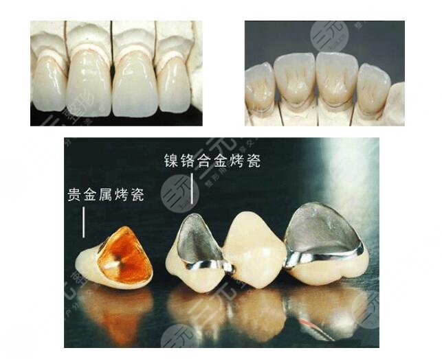 金鈀烤瓷牙價格一般是多少?