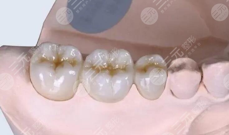 金鈀烤瓷牙價格一般是多少?