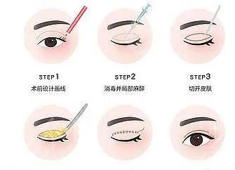沈陽名流整形價格表雙眼皮