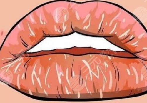 唇部老化的原因有哪些？唇部老化如何改良？