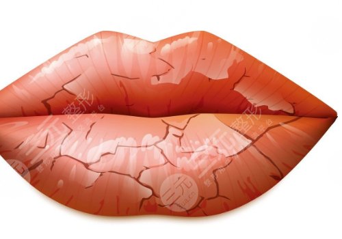唇部老化的原因有哪些？唇部老化如何改良？