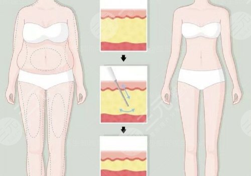 身體塑形能達到減肥的效果嗎？