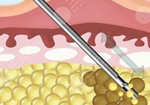 吸脂凹凸不平多久恢復？