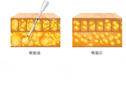 吸脂凹凸不平多久恢復？